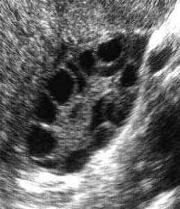 The USS appearance of polycystic ovaries